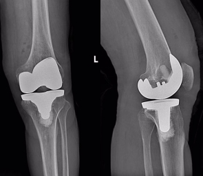 「春雨行动——骨关节置换手术援助公益行」第六批患者顺利康复出院