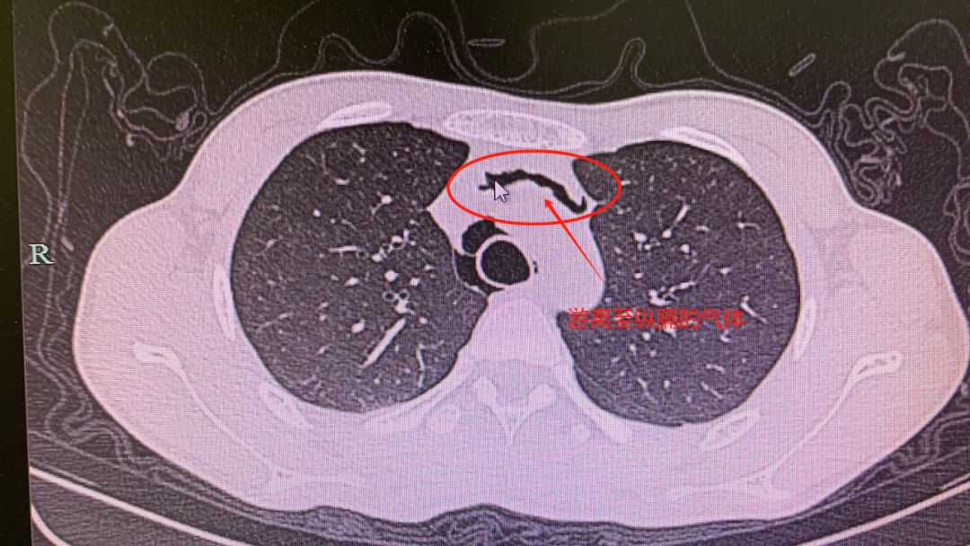 12 岁男孩咳嗽把肺咳「破」了？医生提醒：经常咳嗽的要注意了！