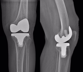 「春雨行动——骨关节置换手术援助公益行」第六批患者顺利康复出院