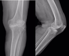 「春雨行动——骨关节置换手术援助公益行」第六批患者顺利康复出院