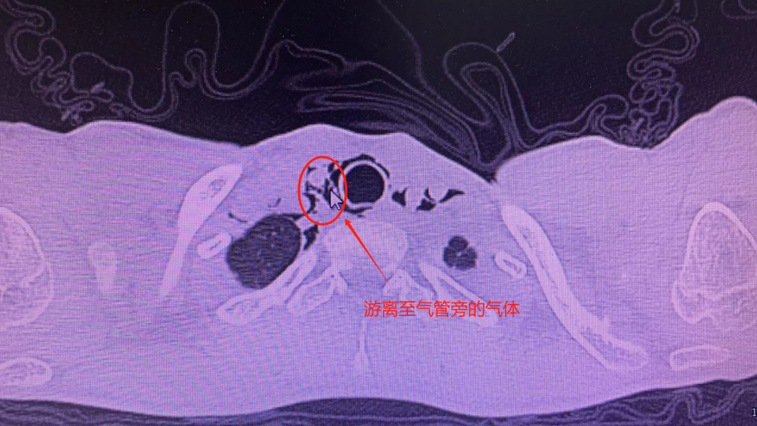 12 岁男孩咳嗽把肺咳「破」了？医生提醒：经常咳嗽的要注意了！