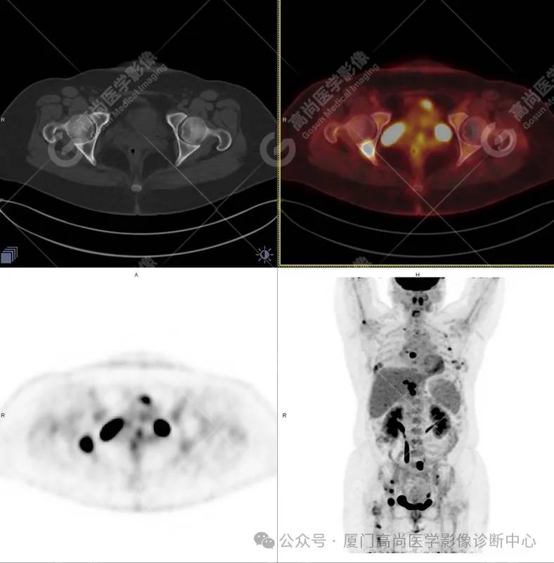 【高尚病例】PET/CT 发现米粒大小的罕见乳腺癌