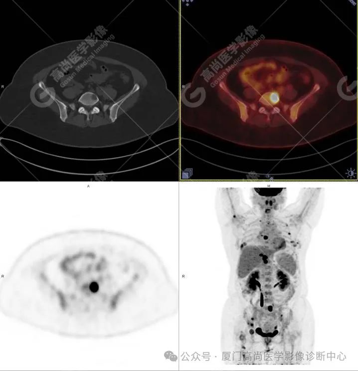 【高尚病例】PET/CT 发现米粒大小的罕见乳腺癌