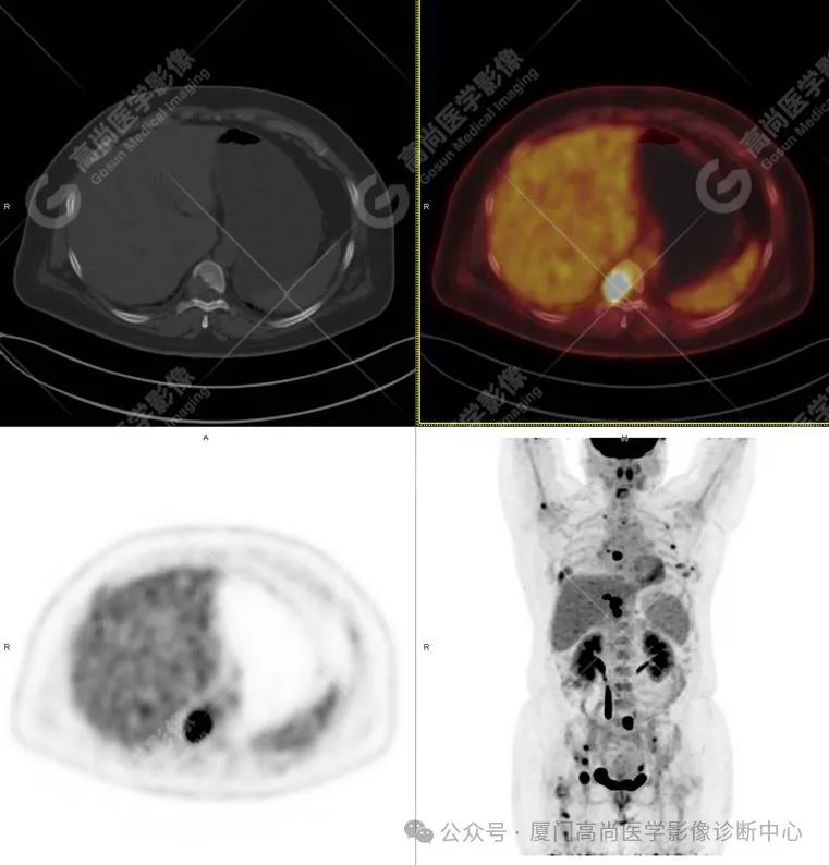 【高尚病例】PET/CT 发现米粒大小的罕见乳腺癌