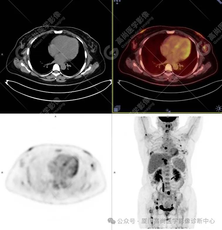 【高尚病例】PET/CT 发现米粒大小的罕见乳腺癌