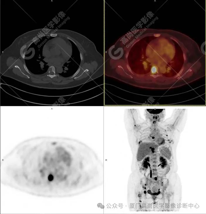 【高尚病例】PET/CT 发现米粒大小的罕见乳腺癌