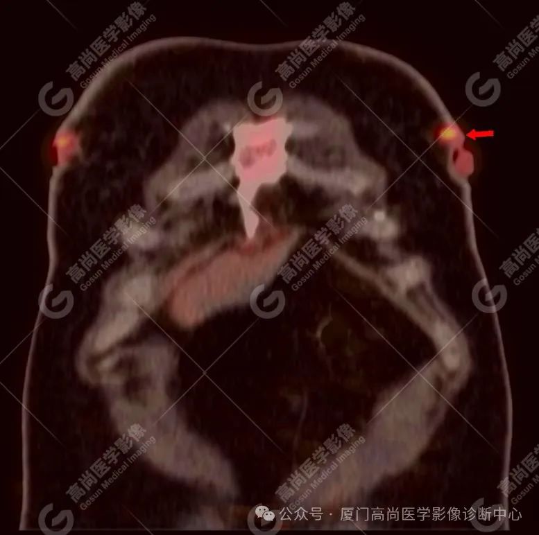 【高尚病例】PET/CT 发现米粒大小的罕见乳腺癌