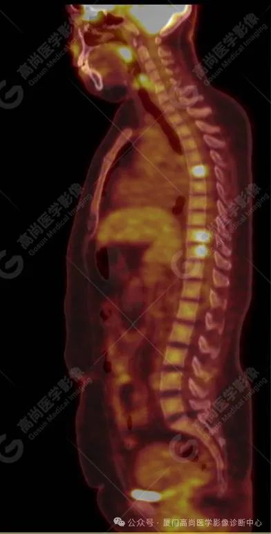 【高尚病例】PET/CT 发现米粒大小的罕见乳腺癌