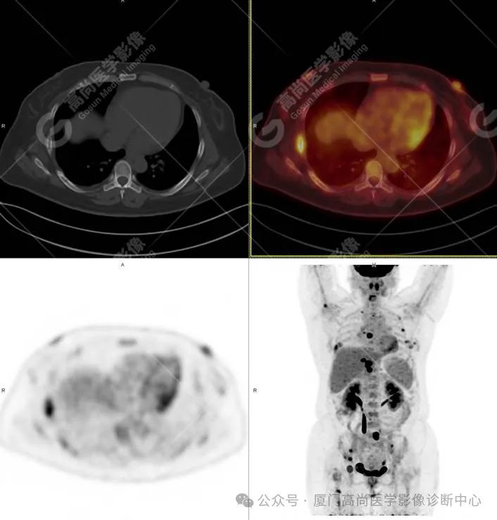【高尚病例】PET/CT 发现米粒大小的罕见乳腺癌
