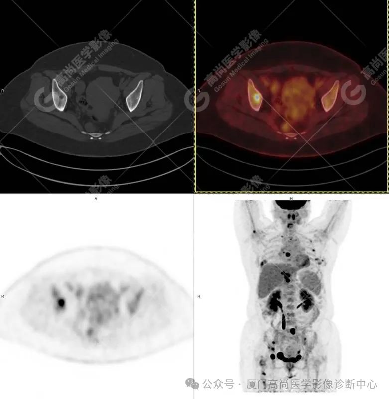 【高尚病例】PET/CT 发现米粒大小的罕见乳腺癌
