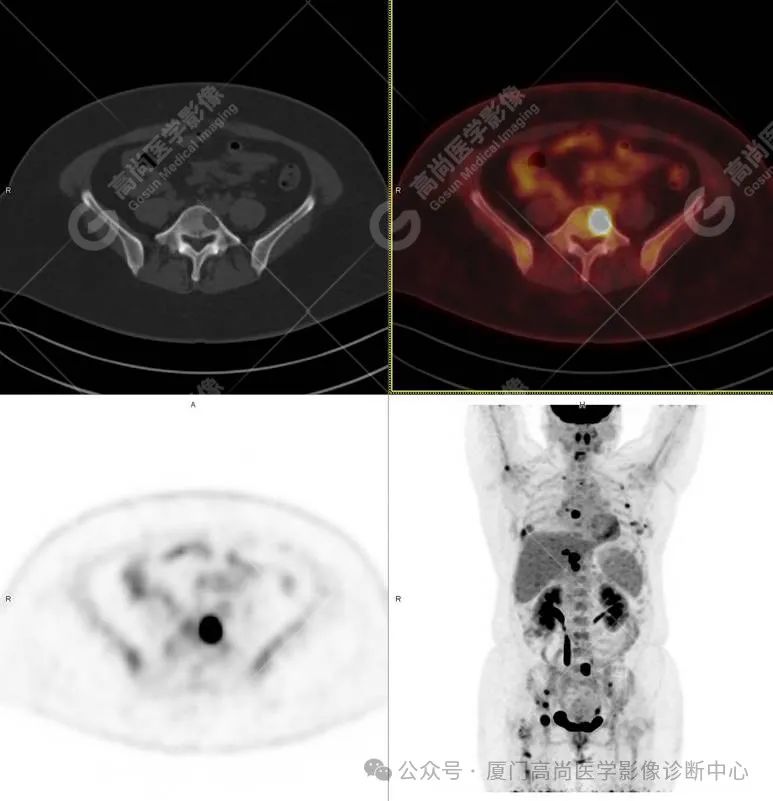 【高尚病例】PET/CT 发现米粒大小的罕见乳腺癌