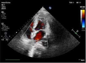 南昌大学第二附属医院完成全国首批生物可降解卵圆孔未闭封堵器植入术
