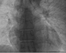 南昌大学第二附属医院完成全国首批生物可降解卵圆孔未闭封堵器植入术