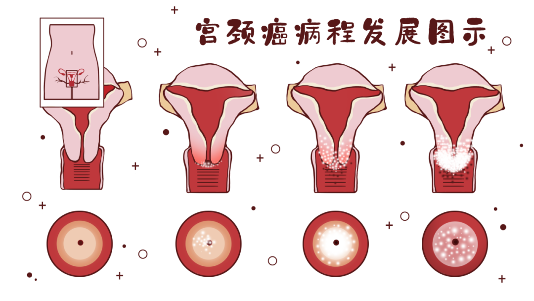 26 岁！宫颈癌！这 4 种早期症状不可忽视……