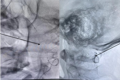 【延安首例】延安市中医医院(北京大学第三医院延安分院)开展 SurpassEvolve 血流导向密网支架植入