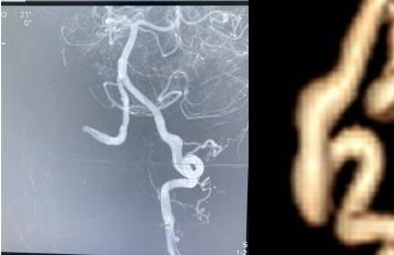 【延安首例】延安市中医医院(北京大学第三医院延安分院)开展 SurpassEvolve 血流导向密网支架植入