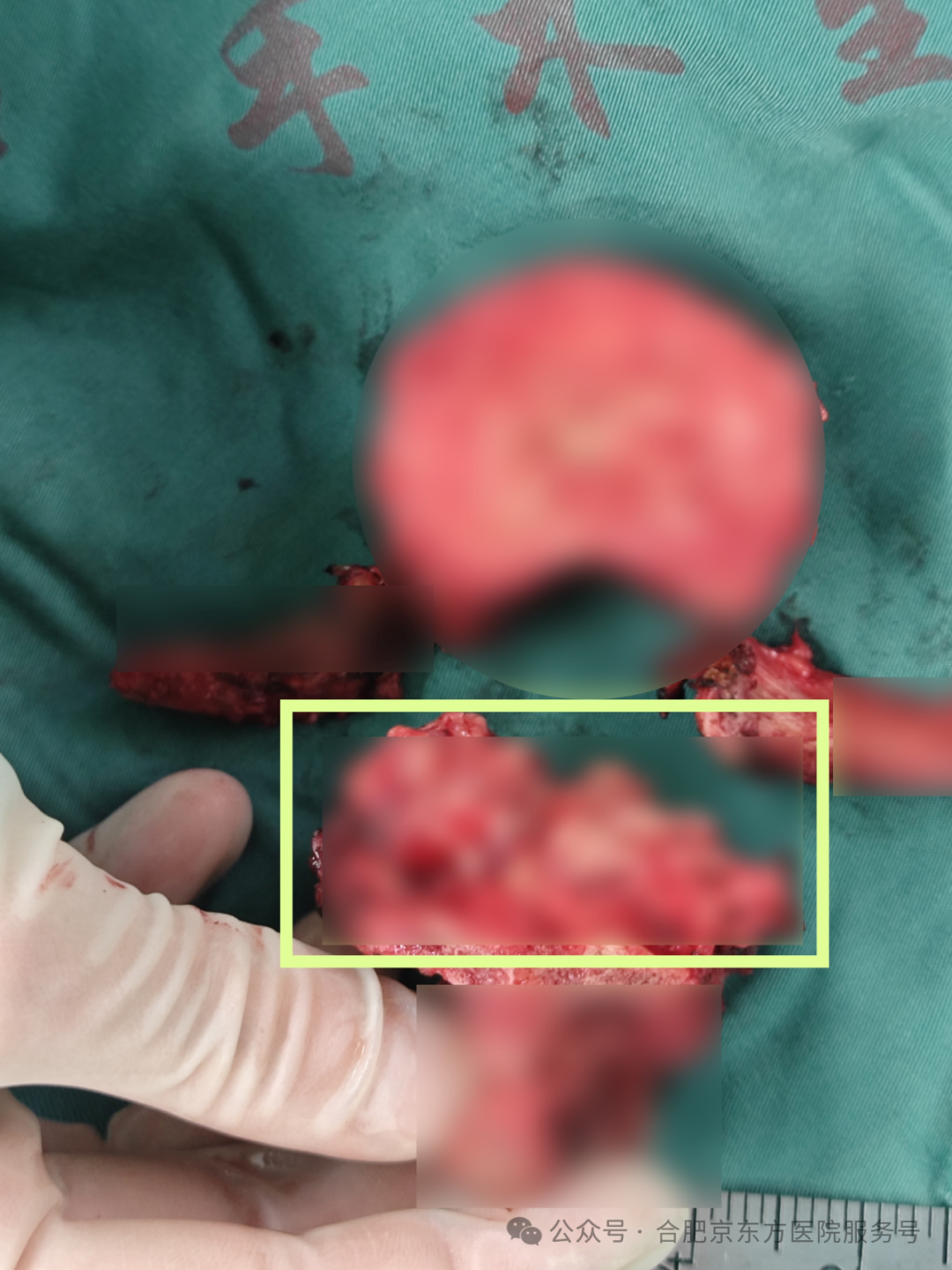 合肥京东方医院：老人腰背痛，查出 2 处癌！这种疼痛要警惕！