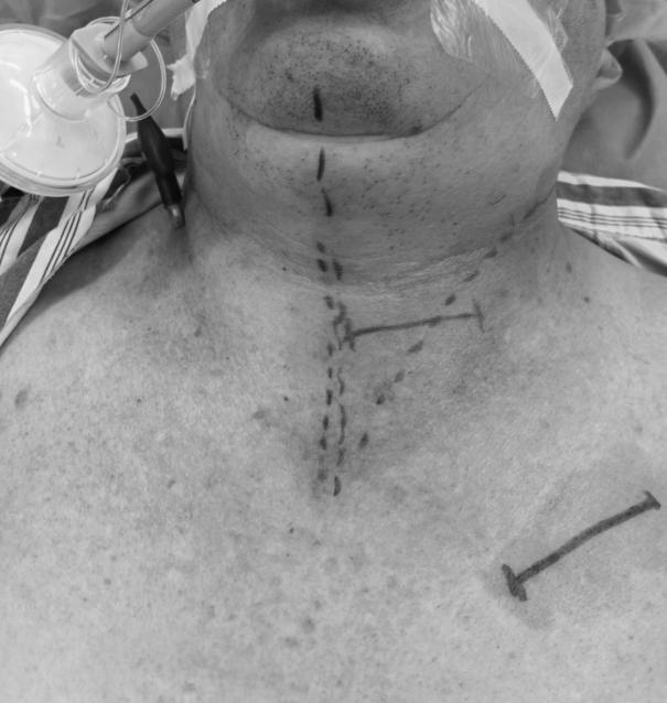 桂林医学院第二附属医院神经外科成功开展药物难治性癫痫 VNS 手术