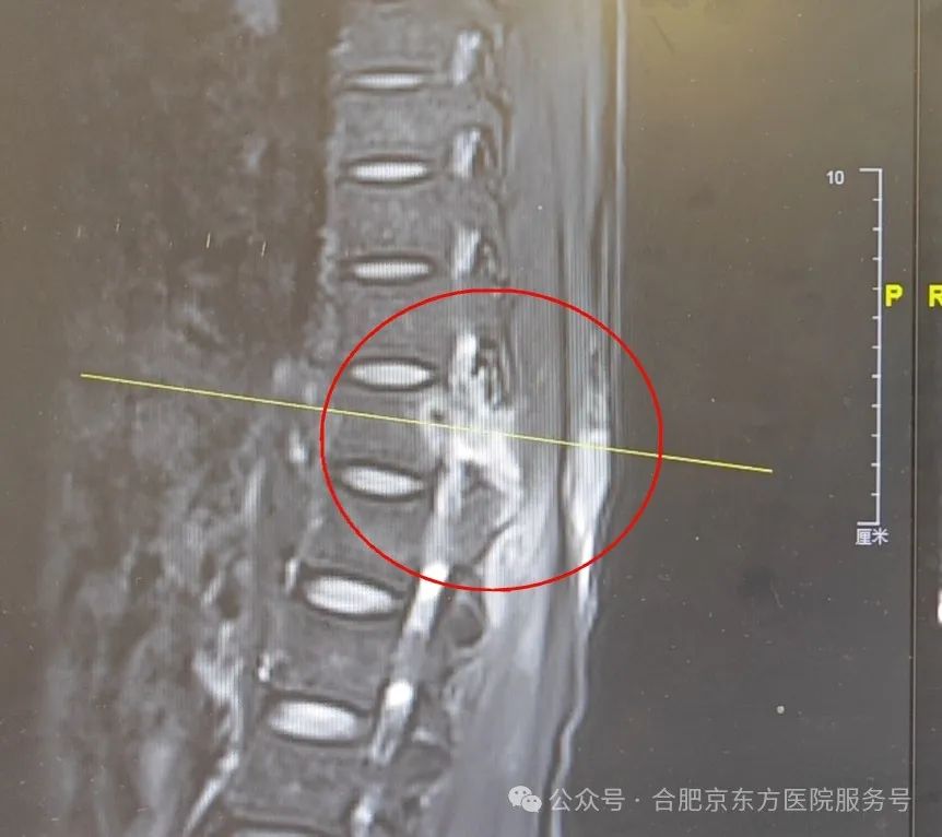 合肥京东方医院：老人腰背痛，查出 2 处癌！这种疼痛要警惕！