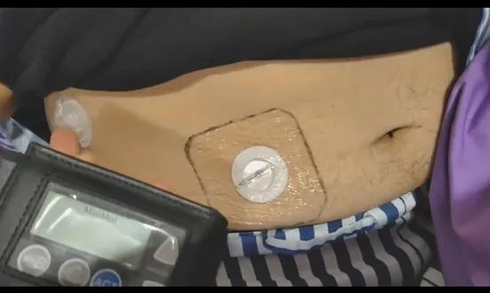 9 岁女童重度糖尿病酮症酸中毒，全力抢救 36 小时转危为安！