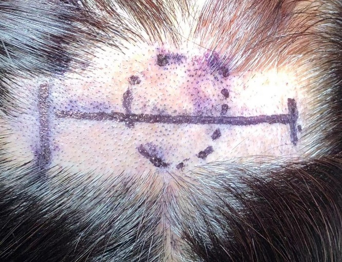 开颅手术可以不剃头吗?能!