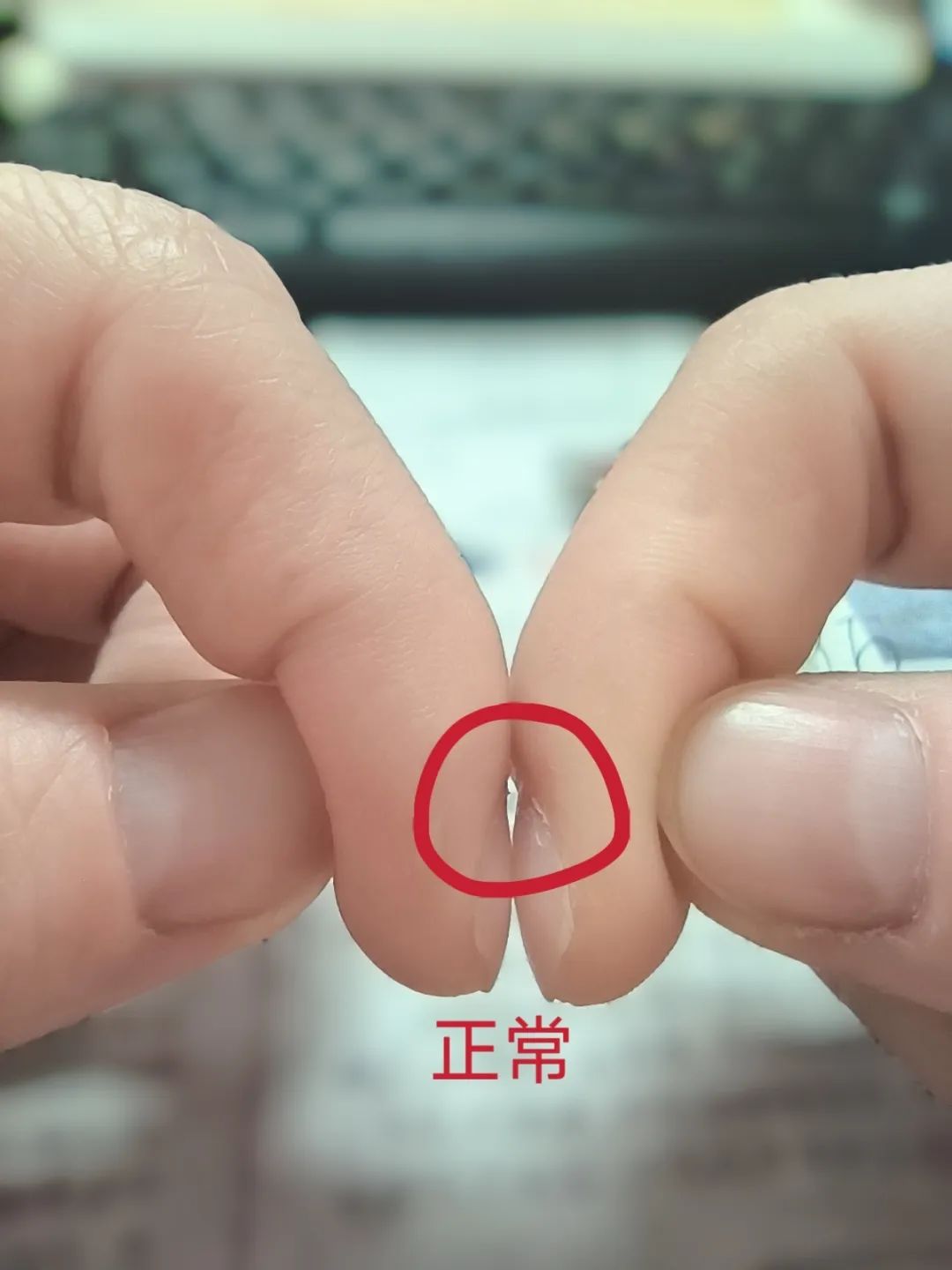 体内有疾，指甲先知？指甲出现这 5 种表现，请务必重视！