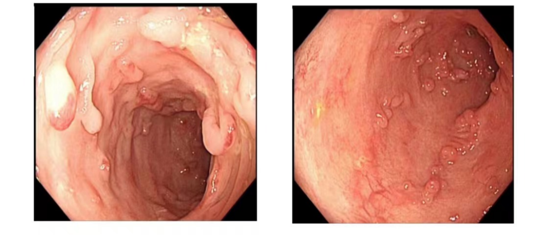 常州市第二人民医院 IBD-MDT 及 GCP 团队携手，一站式诊治难治性 IBD