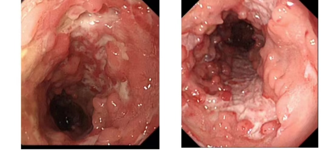 常州市第二人民医院 IBD-MDT 及 GCP 团队携手，一站式诊治难治性 IBD