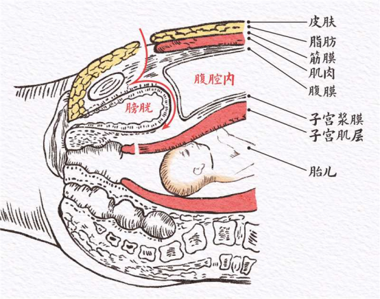 宫腔粘黏太严重！竟意外体验到了冲上热搜的「腹膜外剖宫产」