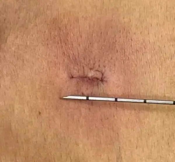 佛山市三水区人民医院脊柱内镜微创手术成功缓解八旬老人巨大腰椎间盘突疼痛