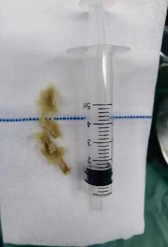 佛山市三水区人民医院脊柱内镜微创手术成功缓解八旬老人巨大腰椎间盘突疼痛