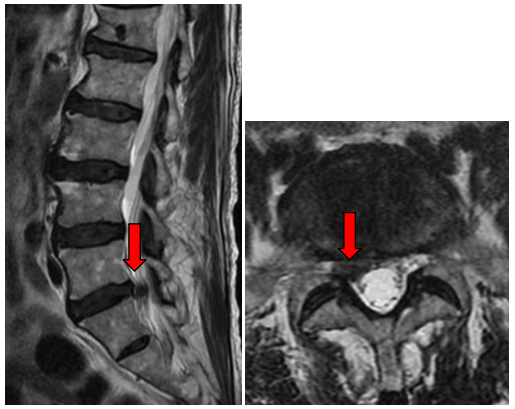 佛山市三水区人民医院脊柱内镜微创手术成功缓解八旬老人巨大腰椎间盘突疼痛