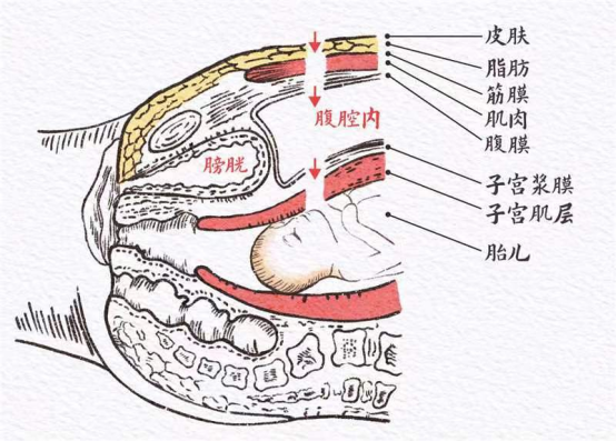 宫腔粘黏太严重！竟意外体验到了冲上热搜的「腹膜外剖宫产」