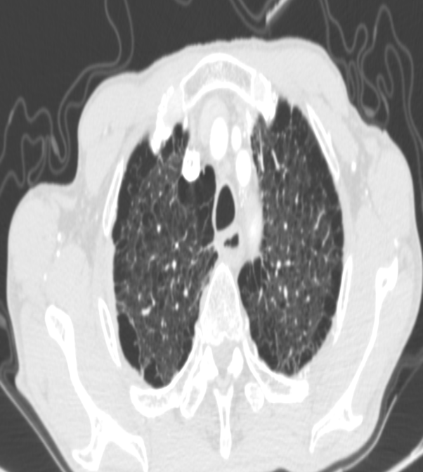 九江市第一人民医院微创手术助力食管癌患者恢复