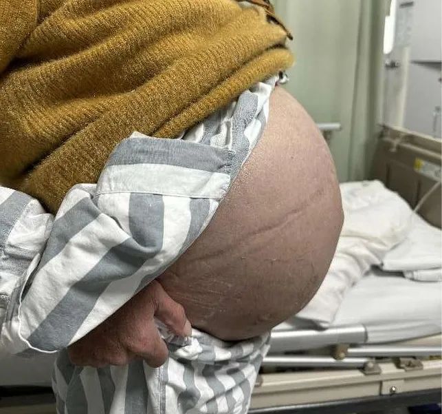 全身肿胀,腹部如鼓,竟是罕见的「铃铛病」!