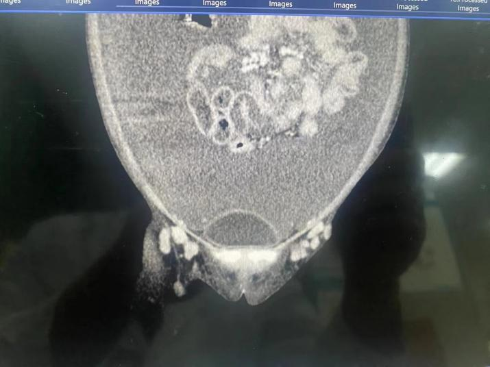 全身肿胀,腹部如鼓,竟是罕见的「铃铛病」!