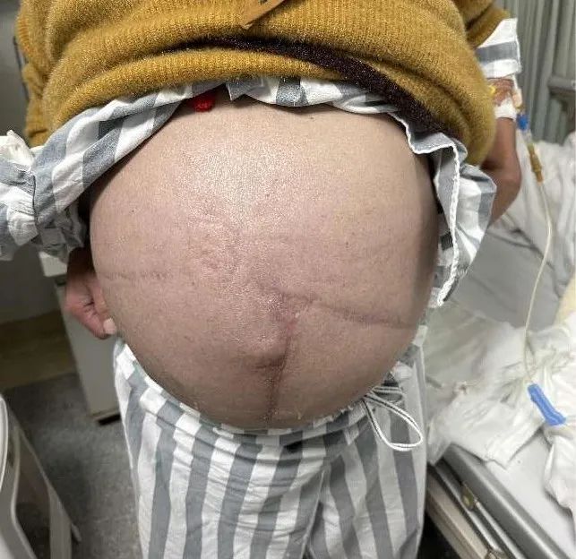 全身肿胀,腹部如鼓,竟是罕见的「铃铛病」!