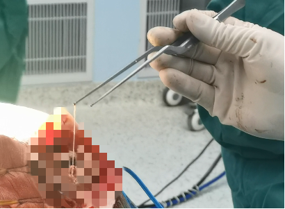 女子脑内惊现 12 厘米寄生虫 广西壮族自治区南溪山医生妙手「捉虫」