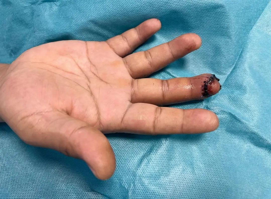 南京江北医院手足显微外科成功完成一例指尖离断再植手术