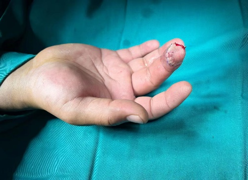 南京江北医院手足显微外科成功完成一例指尖离断再植手术