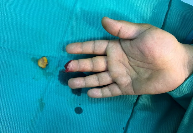 南京江北医院手足显微外科成功完成一例指尖离断再植手术