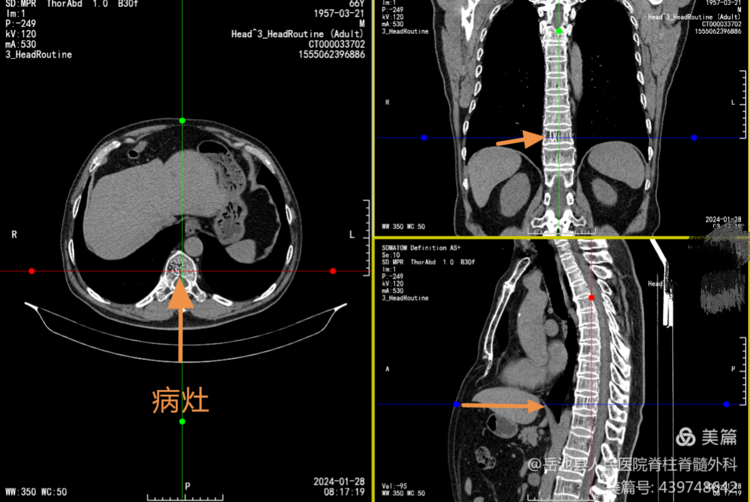 岳医科普 | 椎体血管瘤，不要被名字吓到了！