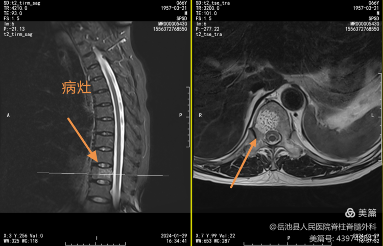 岳医科普 | 椎体血管瘤，不要被名字吓到了！