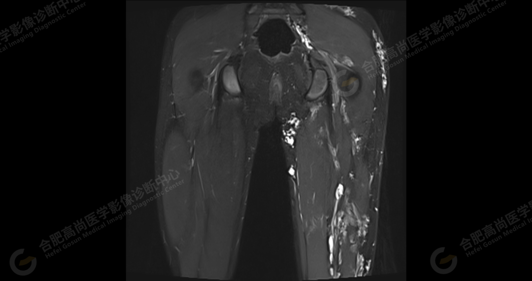 【高尚病例】软组织血管瘤 1 例