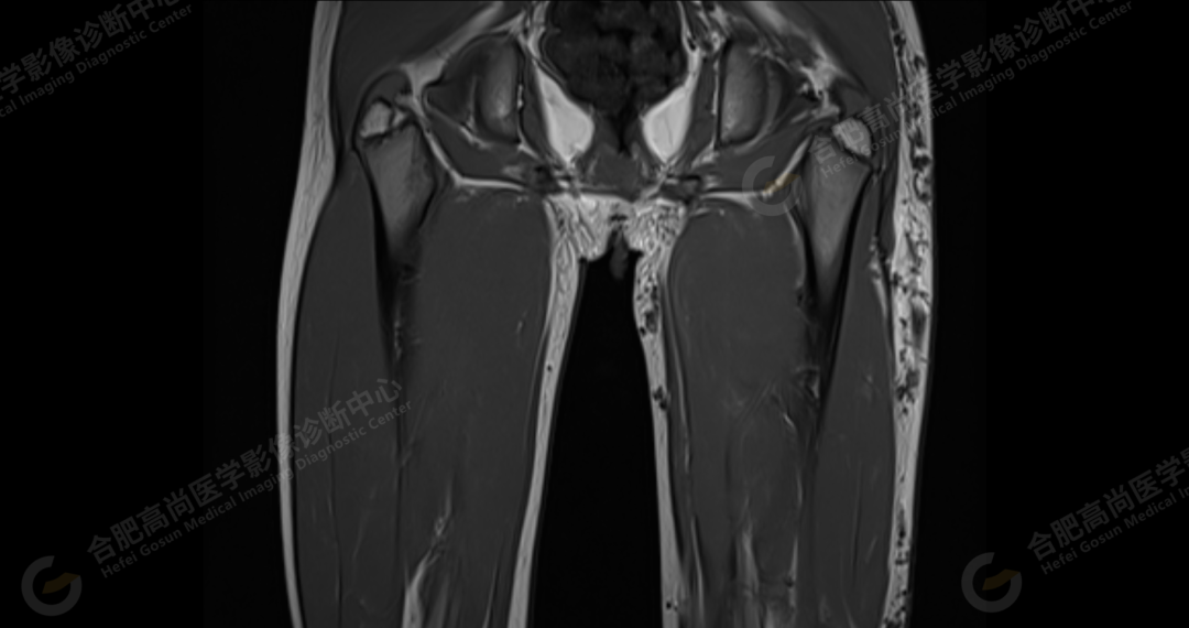 【高尚病例】软组织血管瘤 1 例
