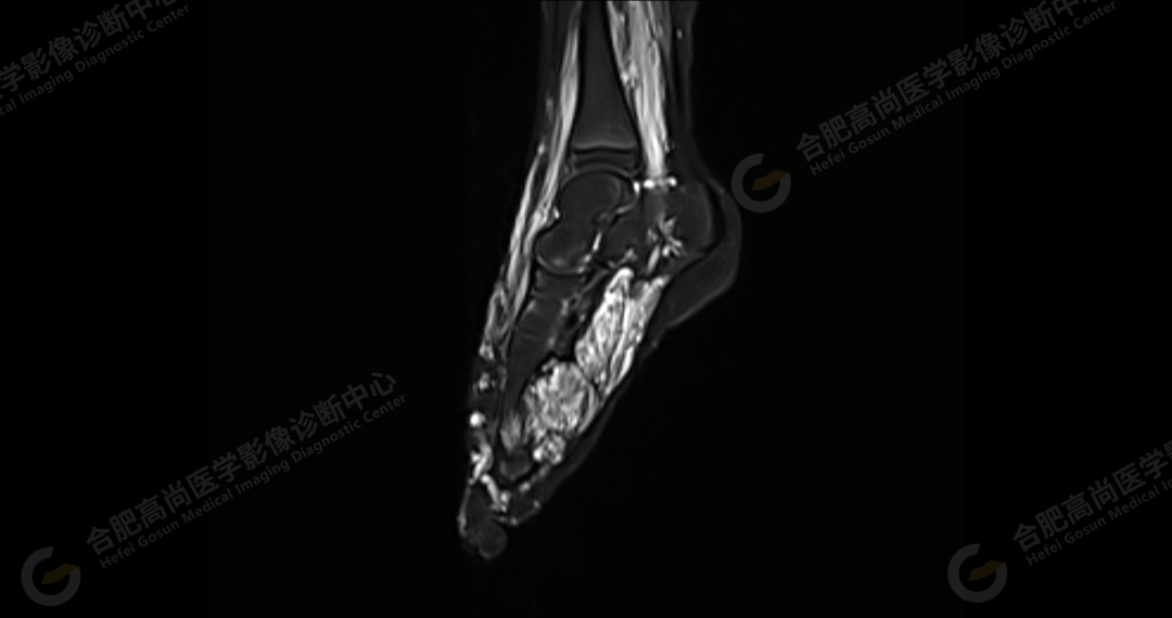 【高尚病例】软组织血管瘤 1 例