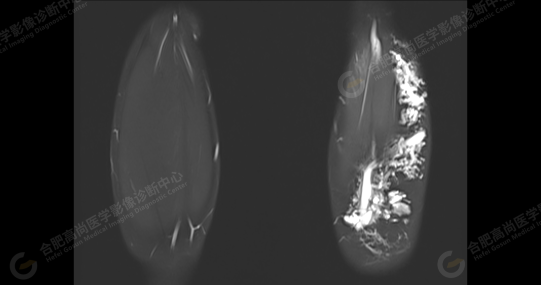 【高尚病例】软组织血管瘤 1 例