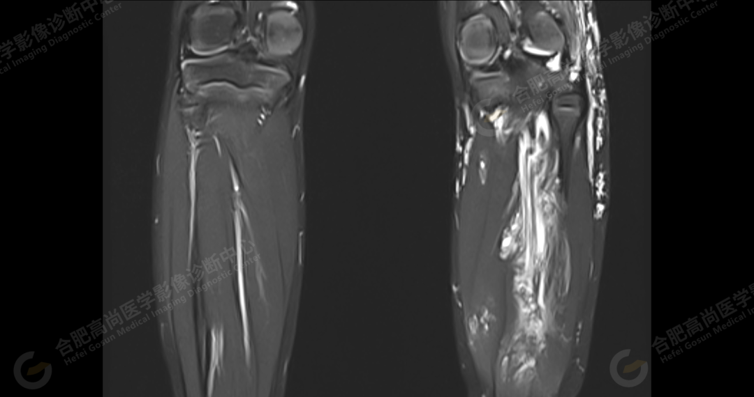 【高尚病例】软组织血管瘤 1 例