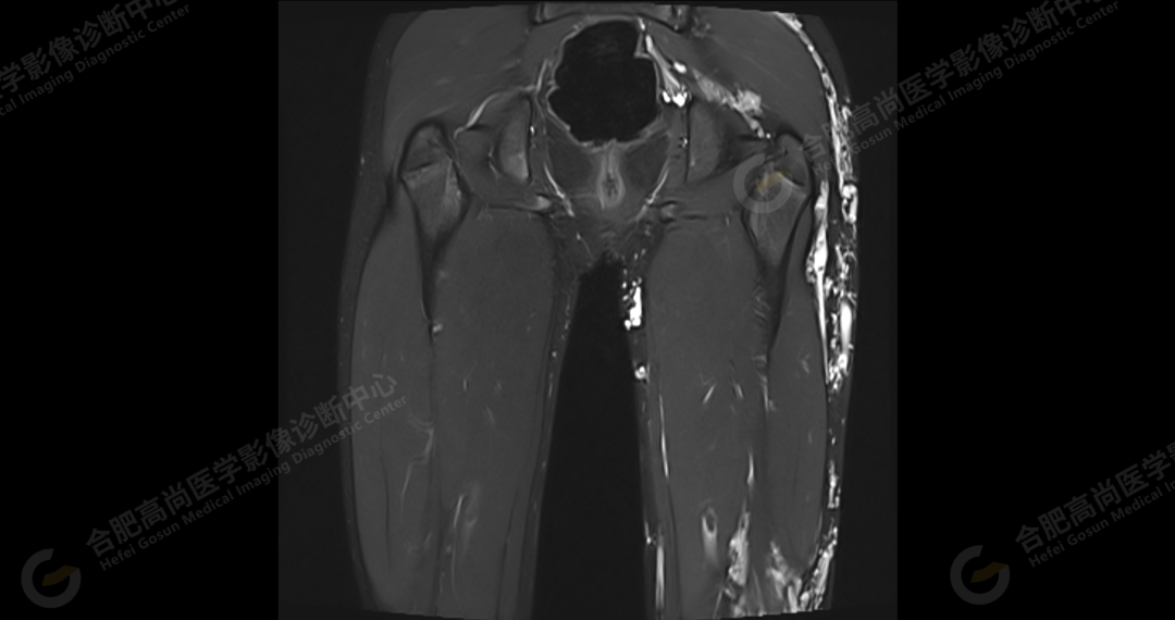 【高尚病例】软组织血管瘤 1 例