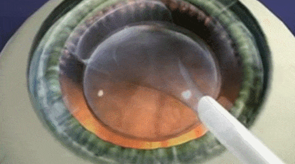 近视手术小知识：什么是「加法」近视手术——ICL?